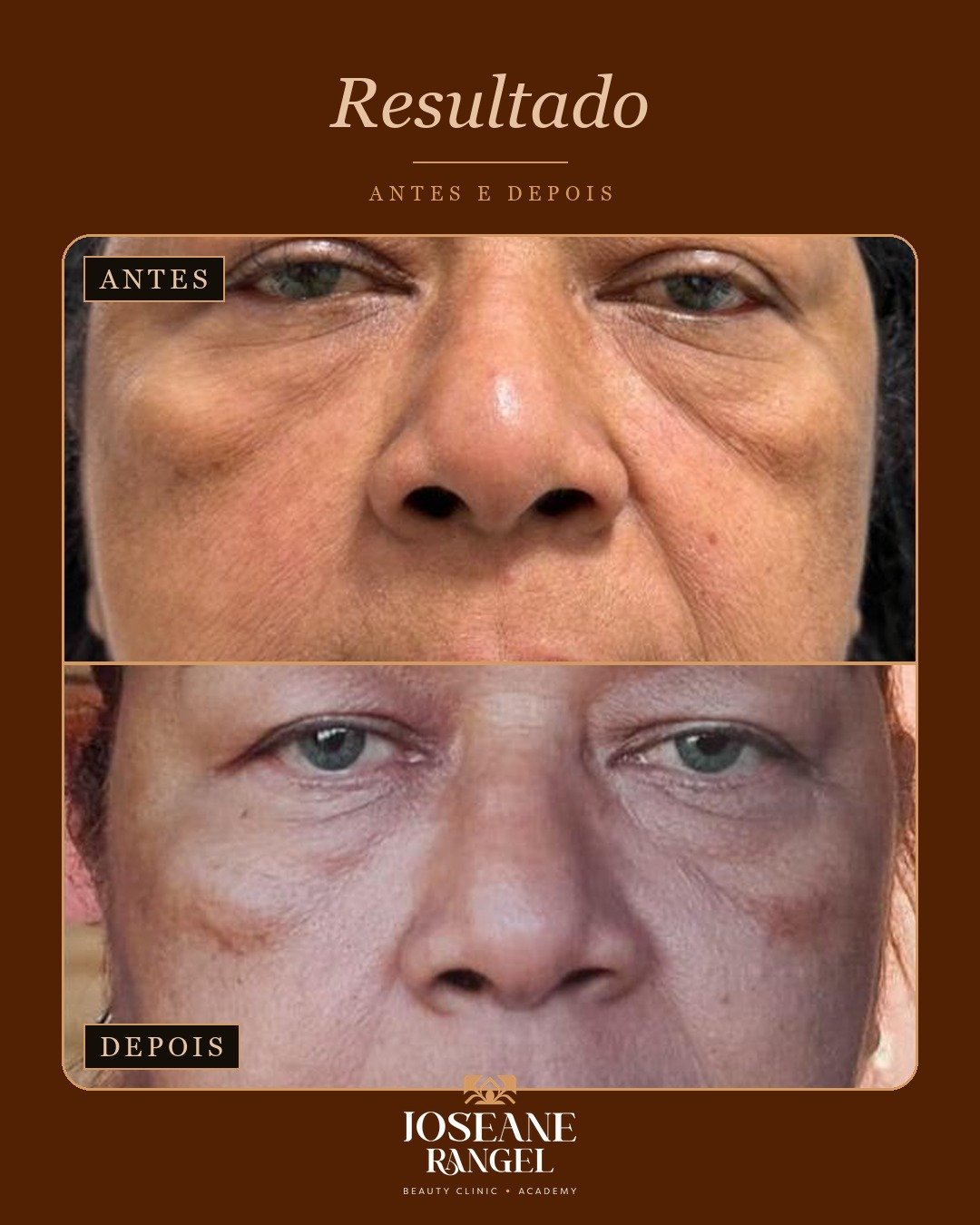 Resultado de estética facial, antes e depois